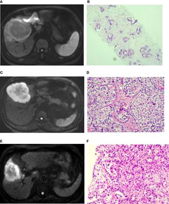 Values of MRI Imaging Presentations in the Hepatobiliary Phase, DWI and T2WI Sequences in Predicting Pathological Grades of Intrahepatic Mass-Forming Cholangiocarcinoma